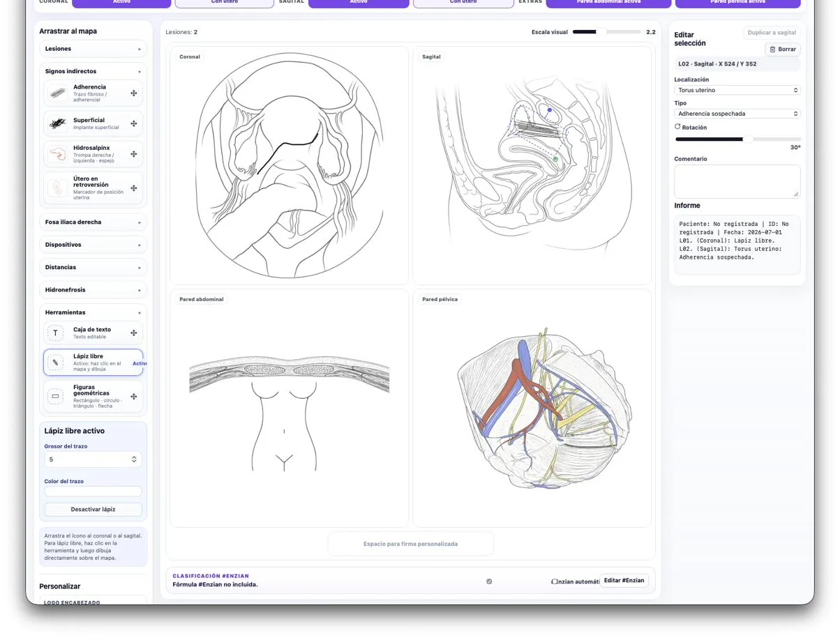 Esquemas coronal, sagital, pared abdominal y pared pélvica con lesiones marcadas