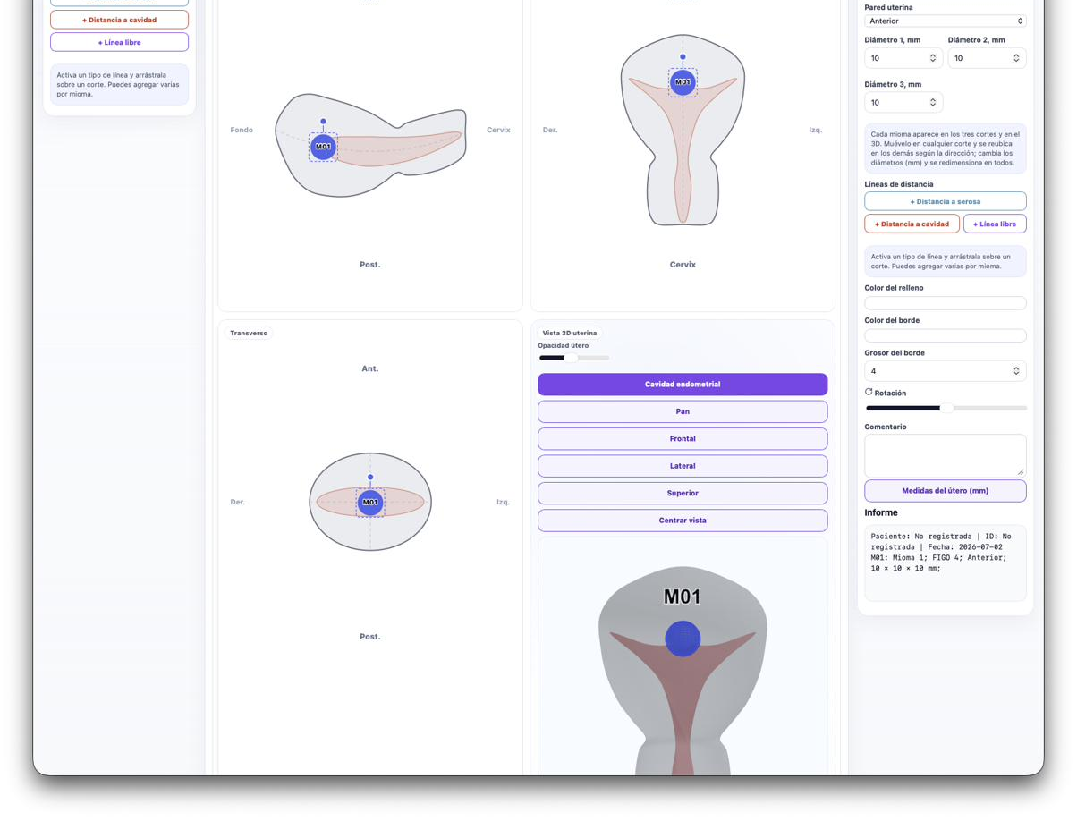 Módulo de miomas con clasificación FIGO y vista 3D uterina