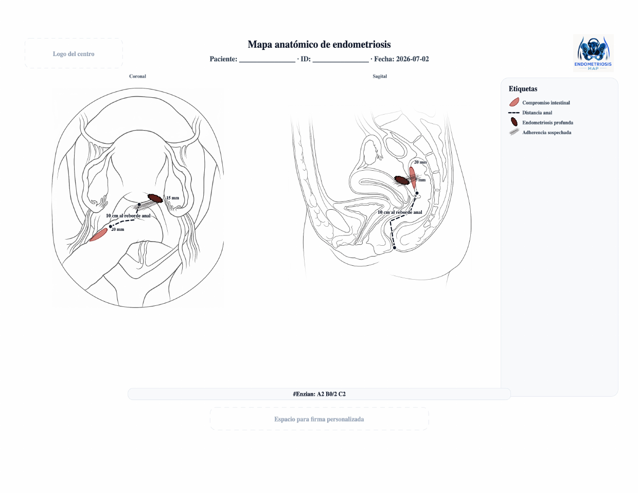 Ejemplo de PDF de mapa anatómico de endometriosis con esquemas coronal y sagital, etiquetas y fórmula #Enzian